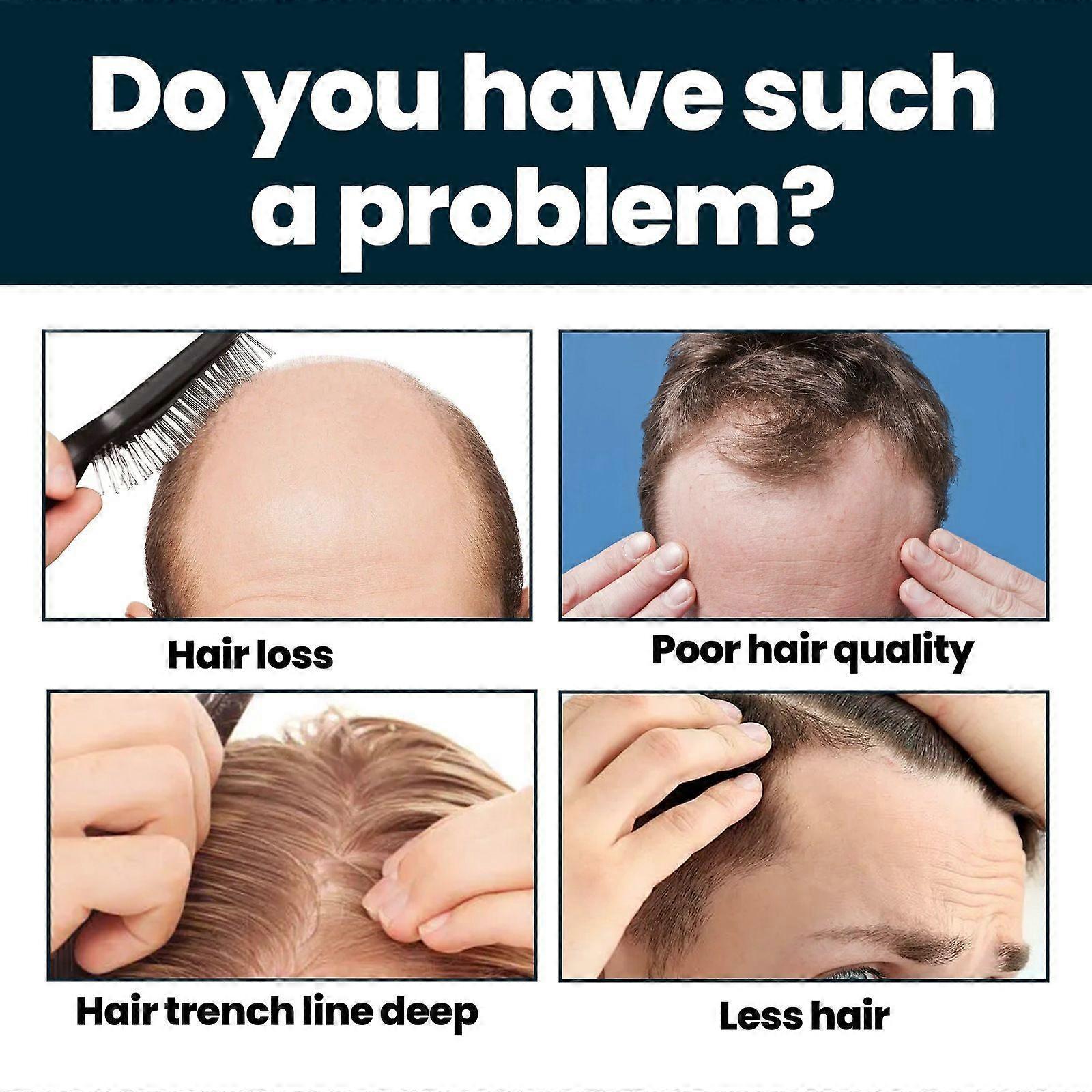 Original Minoxidil Hair Regrowth Extra Strength Topical Hair Loss For Men Solution - Image 2